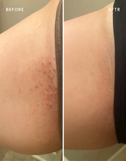 HelloSmooth® – Ingrown Hair Solution