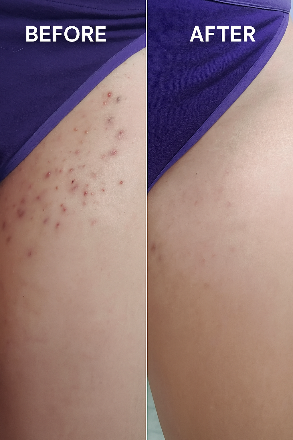 HelloSmooth® – Ingrown Hair Solution