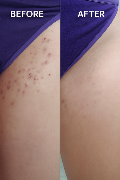 HelloSmooth® – Ingrown Hair Solution