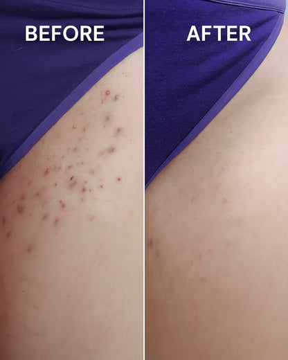 HelloSmooth® – Ingrown Hair Solution